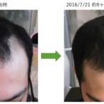 AGAによる薄毛の改善実績 埼玉県八潮市20代男性