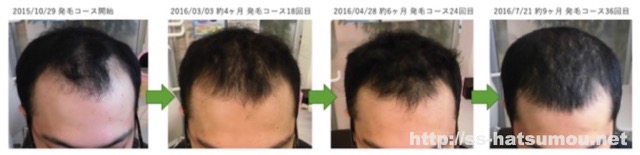 AGA薄毛の改善実績 埼玉県八潮市20代男性