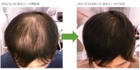 千葉県松戸市 AGA・薄毛30代男性K様の発毛効果 4ヶ月
