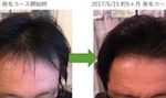 埼玉県川口市 AGA・薄毛の40代男性Y様の5ヶ月での発毛効果