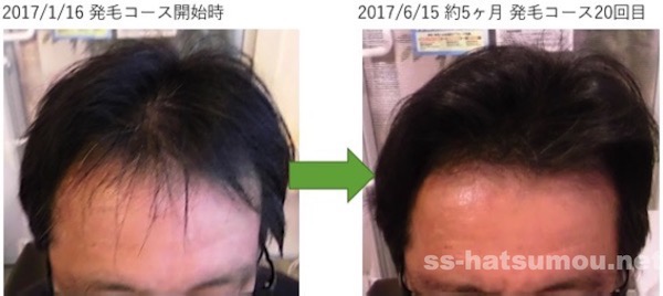 埼玉県川口市 AGA・薄毛の40代男性Y様の5ヶ月での発毛効果