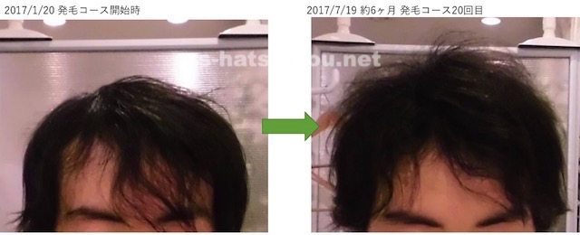 埼玉県久喜市 AGA・薄毛の20代男性K様の6ヶ月での発毛効果 正面