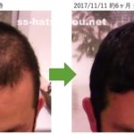 千葉県野田市 30代男性N様のAGA・薄毛の改善例コース開始前と6ヶ月後