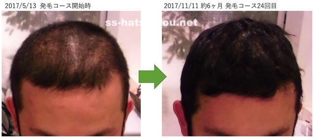千葉県野田市 30代男性N様のAGA・薄毛の改善例コース開始前と6ヶ月後